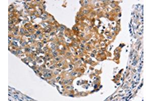 The image on the left is immunohistochemistry of paraffin-embedded Human breast cancer tissue using ABIN7189590(ABCC3 Antibody) at dilution 1/20, on the right is treated with synthetic peptide. (ABCC3 anticorps)