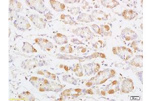 Formalin-fixed and paraffin embedded human colon carcinoma labeled with Anti Phospho-MAP3K8/Tpl2 (Thr290) Polyclonal Antibody, Unconjugated (ABIN746588) at 1:200 followed by conjugation to the secondary antibody and DAB staining (MAP3K8 anticorps  (pThr290))