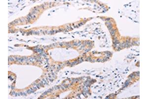 The image on the left is immunohistochemistry of paraffin-embedded Human colon cancer tissue using ABIN7189654(ADAMTS16 Antibody) at dilution 1/50, on the right is treated with synthetic peptide. (ADAMTS16 anticorps)