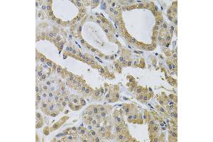 Immunohistochemistry of paraffin-embedded human thyroid cancer using NCF4 Antibody (ABIN1873838) at dilution of 1:100 (40x lens). (NCF4 anticorps)