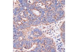 Immunohistochemistry of paraffin-embedded human colon carcinoma using Prohibitin 2 (Prohibitin 2 (PHB2)) Rabbit mAb (ABIN7269545) at dilution of 1:100 (40x lens). (Prohibitin 2 anticorps)