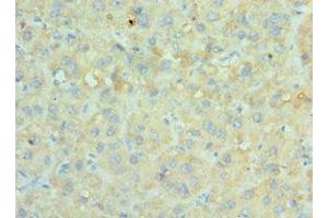 Immunohistochemistry of paraffin-embedded human liver cancer using ABIN7170676 at dilution of 1:100 (SRPK1 anticorps  (AA 290-480))