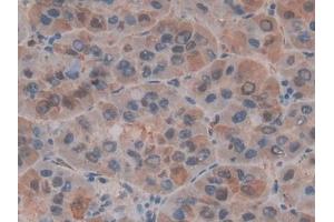 Detection of MIF in Human Liver cancer Tissue using Polyclonal Antibody to Macrophage Migration Inhibitory Factor (MIF)