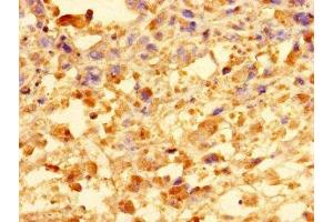 Immunohistochemistry of paraffin-embedded human melanoma using ABIN7148172 at dilution of 1:100 (CCDC91 anticorps  (AA 1-180))