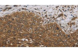 Immunohistochemistry of paraffin-embedded Human cervical cancer tissue using DCTN3 Polyclonal Antibody at dilution 1:70 (DCTN3 anticorps)