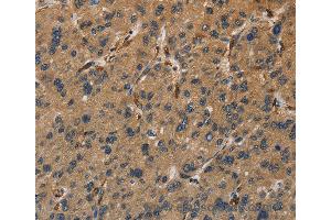 Immunohistochemistry of Human colon cancer using UBE2S Polyclonal Antibody at dilution of 1:40 (UBE2S anticorps)