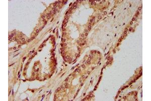 IHC image of ABIN7155513 diluted at 1:400 and staining in paraffin-embedded human prostate cancer performed on a Leica BondTM system. (SETD3 anticorps  (AA 166-265))