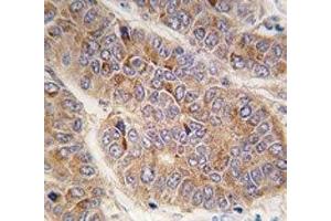 IHC analysis of FFPE human hepatocarcinoma tissue stained with Apolipoprotein A-II antibody