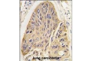 Forlin-fixed and paraffin-embedded hun lung carcino tissue reacted with hP2- antibody, which was peroxidase-conjugated to the secondary antibody, followed by DAB staining. (MAP2 anticorps  (C-Term))