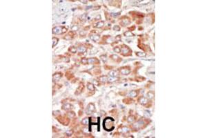 Formalin-fixed and paraffin-embedded human hepatocellular carcinoma tissue reacted with SRPK3 polyclonal antibody  , which was peroxidase-conjugated to the secondary antibody, followed by DAB staining. (SRPK3 anticorps  (Internal Region))