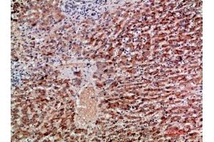 Immunohistochemical analysis of paraffin-embedded human-liver-cancer, antibody was diluted at 1:200. (GDF2 anticorps  (AA 371-420))