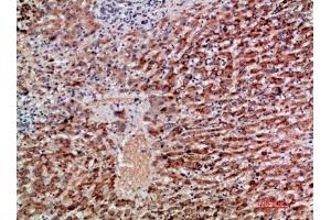 Immunohistochemical analysis of paraffin-embedded human-liver-cancer, antibody was diluted at 1:200.