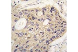 IHC analysis of FFPE human lung carcinoma tissue stained with ATG12 antibody