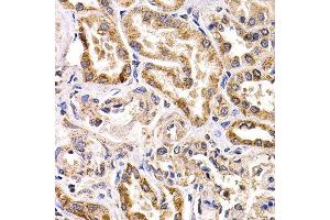 Immunohistochemistry of paraffin-embedded human kidney cancer using FZR1 antibody at dilution of 1:200 (40x lens). (FZR1 anticorps)
