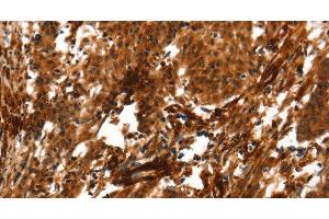Immunohistochemistry of paraffin-embedded Human gastric cancer using ACTA2 Polyclonal Antibody at dilution of 1:40 (Smooth Muscle Actin anticorps)