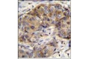 Immunohistochemistry analysis in formalin fixed and paraffin embedded human breast carcinoma reacted with Glutathione reductase Antibody (C-term) followed by peroxidase conjugation of the secondary antibody and DAB staining. (Glutathione Reductase anticorps  (C-Term))