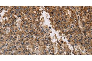 Immunohistochemistry of paraffin-embedded Human liver cancer using KCNK9 Polyclonal Antibody at dilution of 1:40 (KCNK9 anticorps)