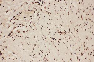 Anti-ALOX5 Picoband antibody,  IHC(P): Human Intestinal Cancer Tissue (ALOX5 anticorps  (AA 120-483))