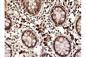 Paraformaldehyde-fixed, paraffin embedded human colon cancer, Antigen retrieval by boiling in sodium citrate buffer (pH6) for 15min, Block endogenous peroxidase by 3% hydrogen peroxide for 30 minutes,  Blocking buffer (normal goat serum) at 37°C for 20min, Antibody incubation with NDRG1 (Thr346) Polyclonal Antibody at 1:400 overnight at 4°C, followed by a conjugated secondary and DAB staining.