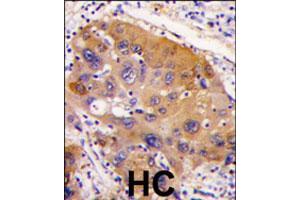 Formalin-fixed and paraffin-embedded human hepatocellular carcinoma reacted with NNMT polyclonal antibody  , which was peroxidase-conjugated to the secondary antibody, followed by DAB staining. (NNMT anticorps  (AA 77-106))