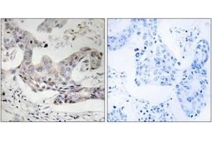 Immunohistochemistry analysis of paraffin-embedded human breast carcinoma tissue, using ALDH3B1 Antibody. (ALDH3B1 anticorps  (AA 51-100))