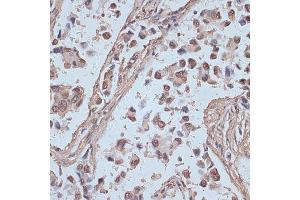 Immunohistochemistry of paraffin-embedded human lung cancer using SNW1 antibody (ABIN7270386) at dilution of 1:100 (40x lens).