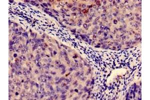 Immunohistochemistry analysis of human cervical cancer using ABIN7156207 at dilution of 1:100