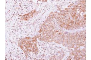 IHC-P Image Immunohistochemical analysis of paraffin-embedded human breast cancer, using GSPT1, antibody at 1:500 dilution. (GSPT1 anticorps)