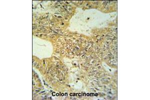CLDN23 Antibody IHC analysis in formalin fixed and paraffin embedded colon carcinoma followed by peroxidase conjugation of the secondary antibody and DAB staining. (Claudin 23 anticorps  (C-Term))