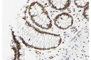 ABIN6269058 at 1/200 staining human colon carcinoma tissue sections by IHC-P. (FOXO3 anticorps  (Internal Region))