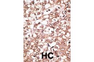 Formalin-fixed and paraffin-embedded human cancer tissue reacted with the primary antibody, which was peroxidase-conjugated to the secondary antibody, followed by AEC staining.