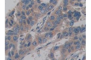 DAB staining on IHC-P;;Samples: Human Breast cancer Tissue