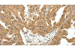 Immunohistochemistry of paraffin-embedded Human ovarian cancer using PTCH1 Polyclonal Antibody at dilution of 1:50 (Patched 1 anticorps)