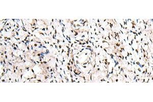Immunohistochemistry of paraffin-embedded Human cervical cancer tissue using ZNF207 Polyclonal Antibody at dilution of 1:30(x200) (ZNF207 anticorps)