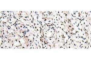 Immunohistochemistry of paraffin-embedded Human cervical cancer tissue using ZNF207 Polyclonal Antibody at dilution of 1:30(x200)