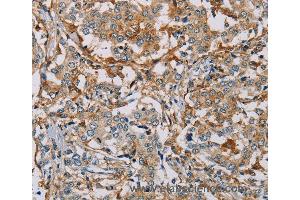 Immunohistochemistry of Human liver cancer using MSR1 Polyclonal Antibody at dilution of 1:30 (Macrophage Scavenger Receptor 1 anticorps)
