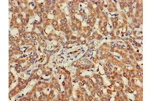 Immunohistochemistry of paraffin-embedded human liver cancer using ABIN7142959 at dilution of 1:100 (CHRNB1 anticorps  (AA 24-244))