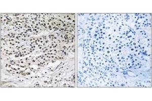 Immunohistochemistry analysis of paraffin-embedded human breast carcinoma tissue, using AZI1 Antibody. (AZI1 anticorps  (AA 311-360))