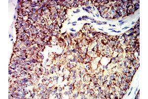 Immunohistochemical analysis of paraffin-embedded bladder cancer tissues using BAK1 mouse mAb with DAB staining.