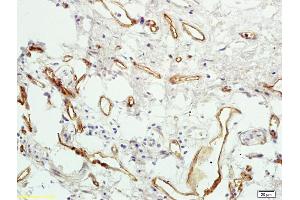 Formalin-fixed and paraffin embedded human colon carcinoma labeled with Rabbit Anti PAR4 Polyclonal Antibody, Unconjugated (ABIN673224) at 1:200 followed by conjugation to the secondary antibody and DAB staining (F2RL3 anticorps  (AA 320-343))