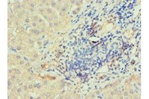 Immunohistochemistry of paraffin-embedded human liver cancer using ABIN7156754 at dilution of 1:100 (IRAK2 anticorps  (AA 1-270))