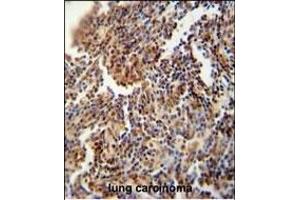HFM1 antibody (C-term) (ABIN654571 and ABIN2844275) immunohistochemistry analysis in formalin fixed and paraffin embedded human lung carcinoma followed by peroxidase conjugation of the secondary antibody and DAB staining. (HFM1 anticorps  (C-Term))