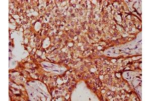 IHC image of ABIN7175349 diluted at 1:300 and staining in paraffin-embedded human cervical cancer performed on a Leica BondTM system.