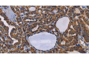 Immunohistochemistry of paraffin-embedded Human thyroid cancer tissue using GRK3 Polyclonal Antibody at dilution 1:50 (ADRBK2 anticorps)