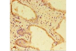 Immunohistochemistry of paraffin-embedded human prostate cancer using ABIN7168303 at dilution of 1:100 (RTF1 anticorps  (AA 620-670))