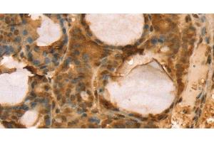 Immunohistochemistry of paraffin-embedded Human thyroid cancer using TAF11 Polyclonal Antibody at dilution of 1:40 (TAF11 anticorps)