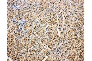 Anti-Kallistatin antibody, IHC(P) IHC(P): Human Liver Cancer Tissue