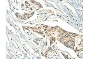 Immunohistochemical analysis of paraffin-embedded human breast carcinoma showing cytoplasmic staining with ZC3H11A polyclonal antibody  at a 1 : 100 dilution. (ZC3H11A anticorps  (AA 332-585))