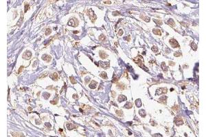 ABIN6277339 at 1/100 staining Human breast cancer tissue by IHC-P. (PDCD10 anticorps  (Internal Region))