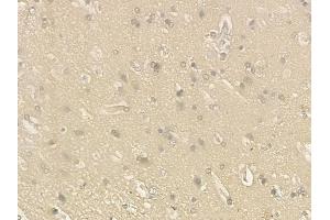 ABIN6263609 and ABIN6276550 at 1/100 staining human glioblastoma by IHC-P.